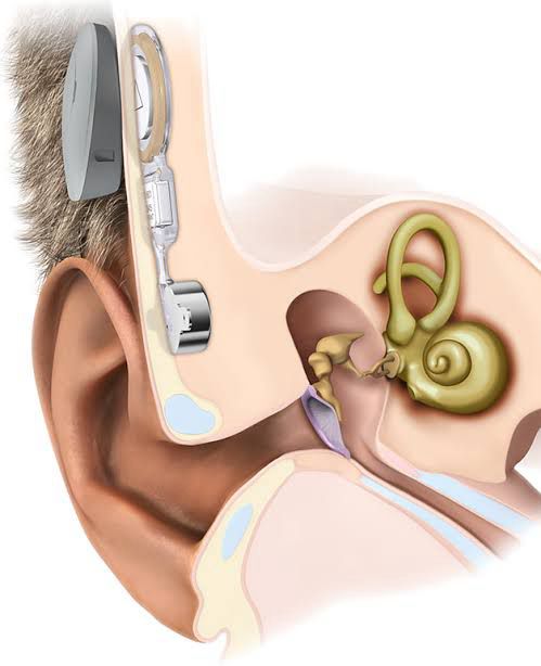 bone anchored hearing aids (BAHA) solution